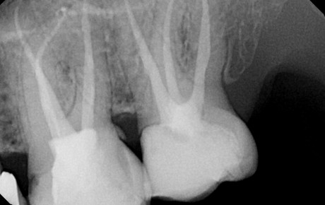 endodoncija