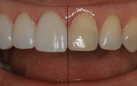 ljuskice prije poslje